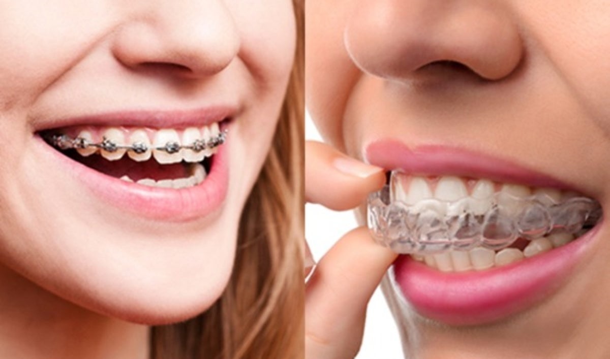 Invisalign vs. Traditional Braces: What's the Difference?