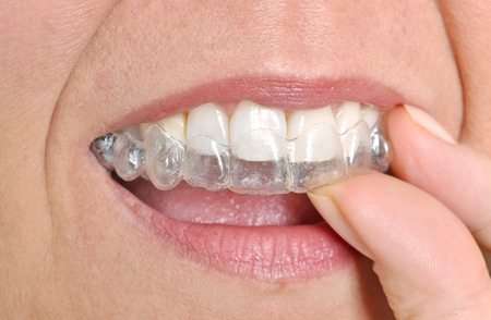Invisalign treatment in Concord Mills and Northlake, NC.