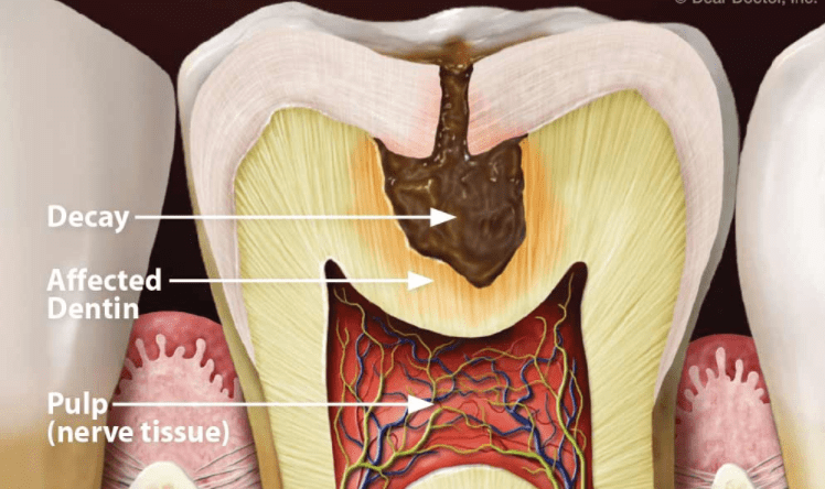 Dentin decay