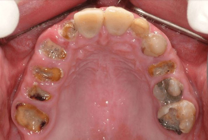 Severe Tooth Decay Before And After