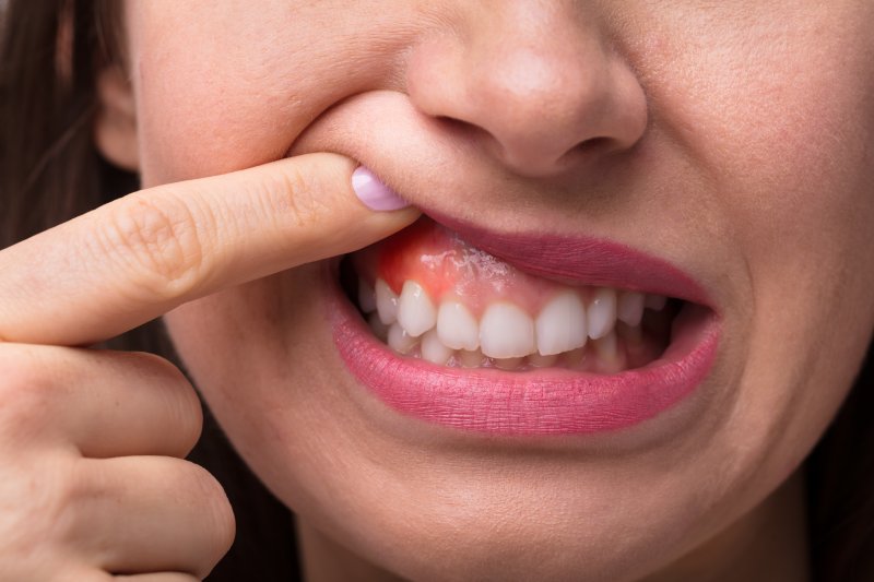 The fastest way to quickly heal swollen gums in Charlotte and Concord, NC