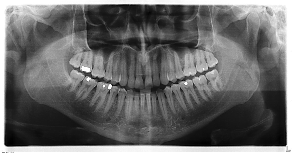 Dental X-rays in Charlotte and Concord, NC