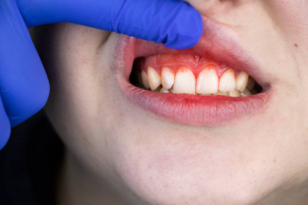 The Relationship between Gum Disease and Overall Well-Being in Concord near Charlotte, NC